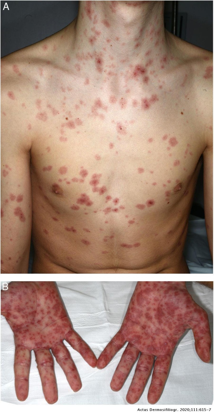 Stevens-Johnson Syndrome Secondary to Doxycycline Treatment in a